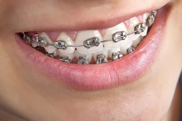 Bond strength and brackets: to etch or not to etch?
