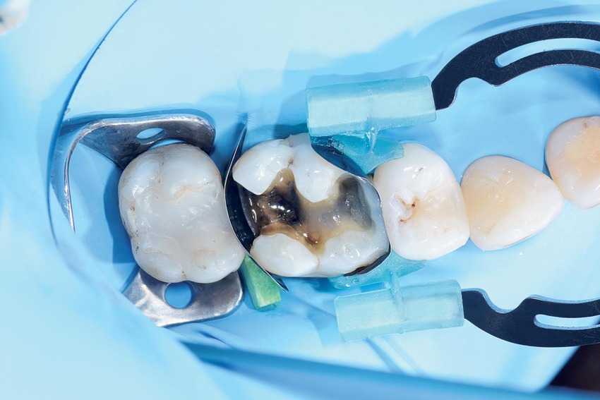 myTines (Polydentia) Sky Dental Supply